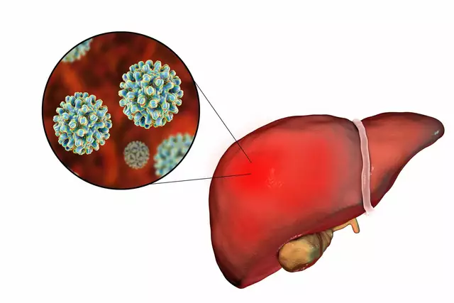 Ursodiol and Hepatitis: Can This Medication Help with Viral Liver Diseases?